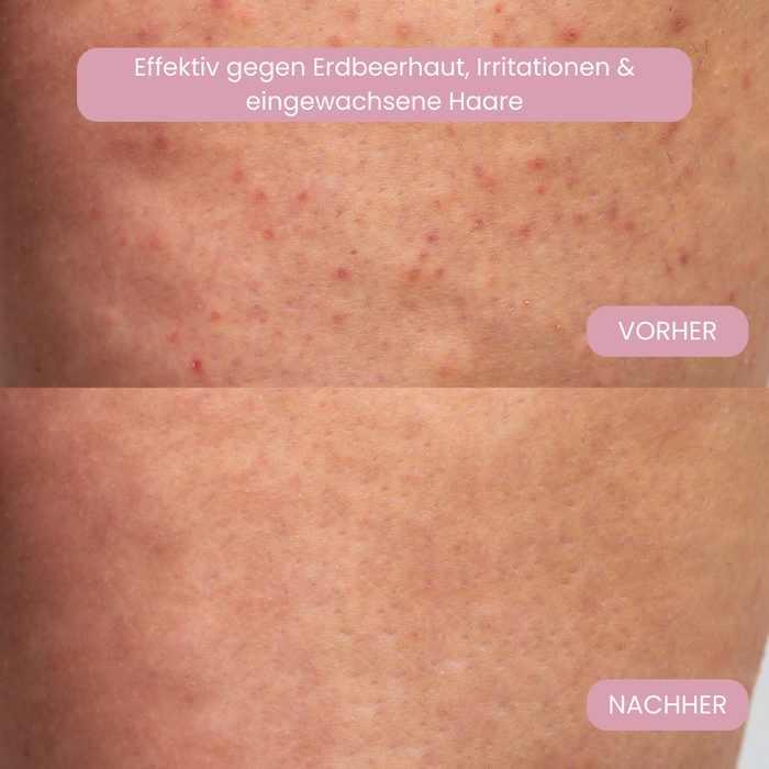 Vorher-Nachher Erdbeerhaut